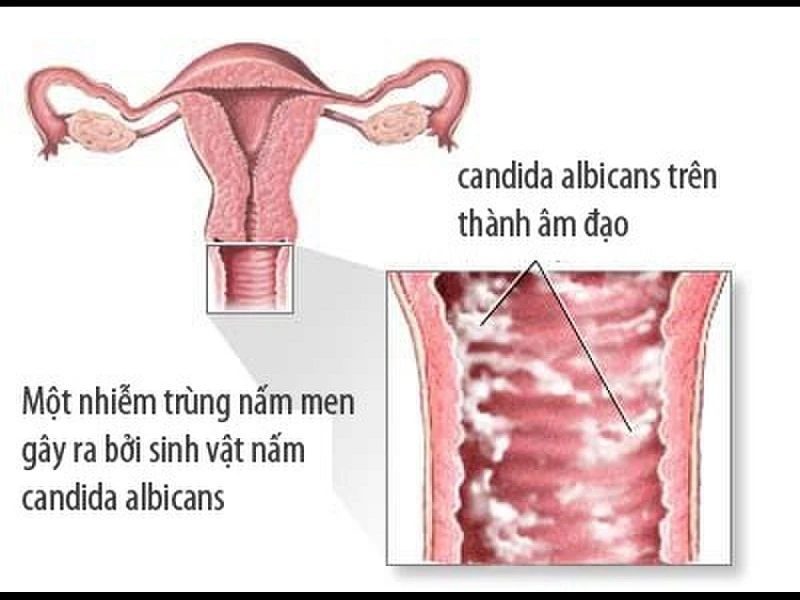 Bật mí 4 cách chữa nấm âm đao tại nhà cực kỳ đơn giản