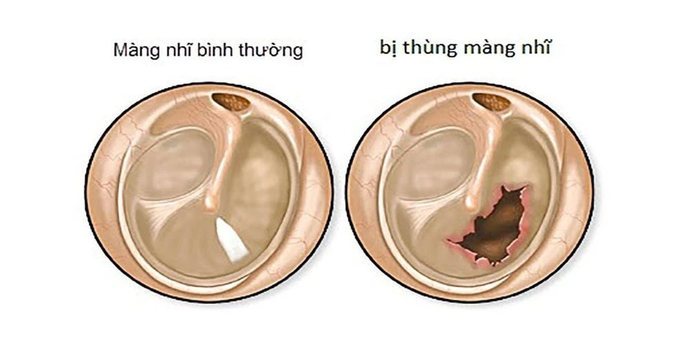 Thủng màng nhĩ có tự liền được không?