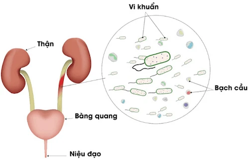 5 cách chữa viêm đường tiết niệu tại nhà hiệu quả