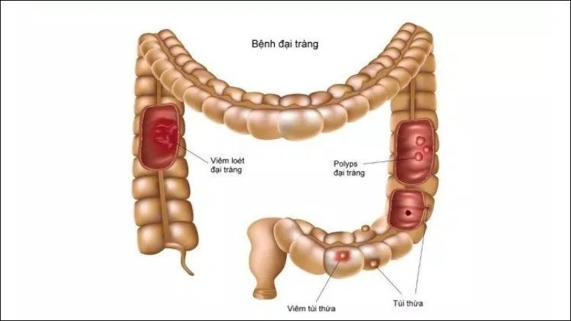 14 cách chữa viêm đại tràng tại nhà đơn giản, hiệu quả và an toàn