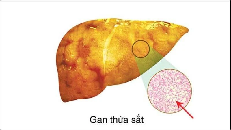 Bệnh thừa sắt: Triệu chứng, nguyên nhân và cách điều trị