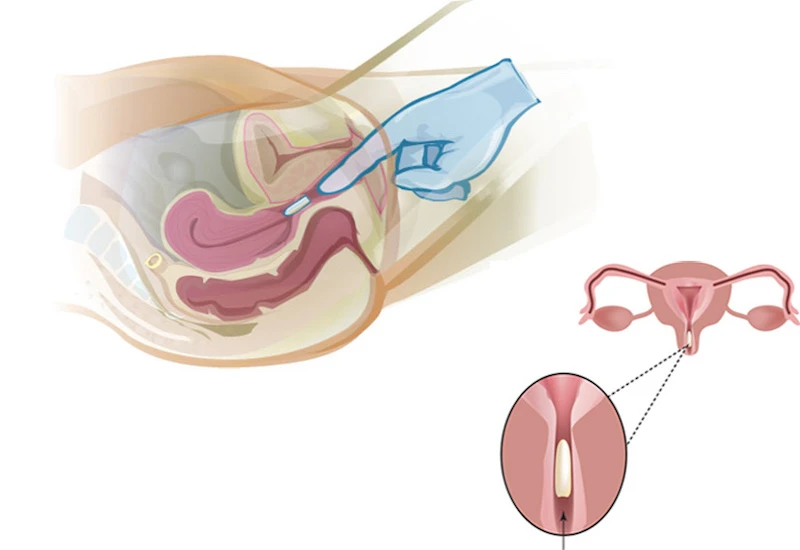 Công dụng của thuốc đặt âm đạo và những lưu ý khi sử dụng