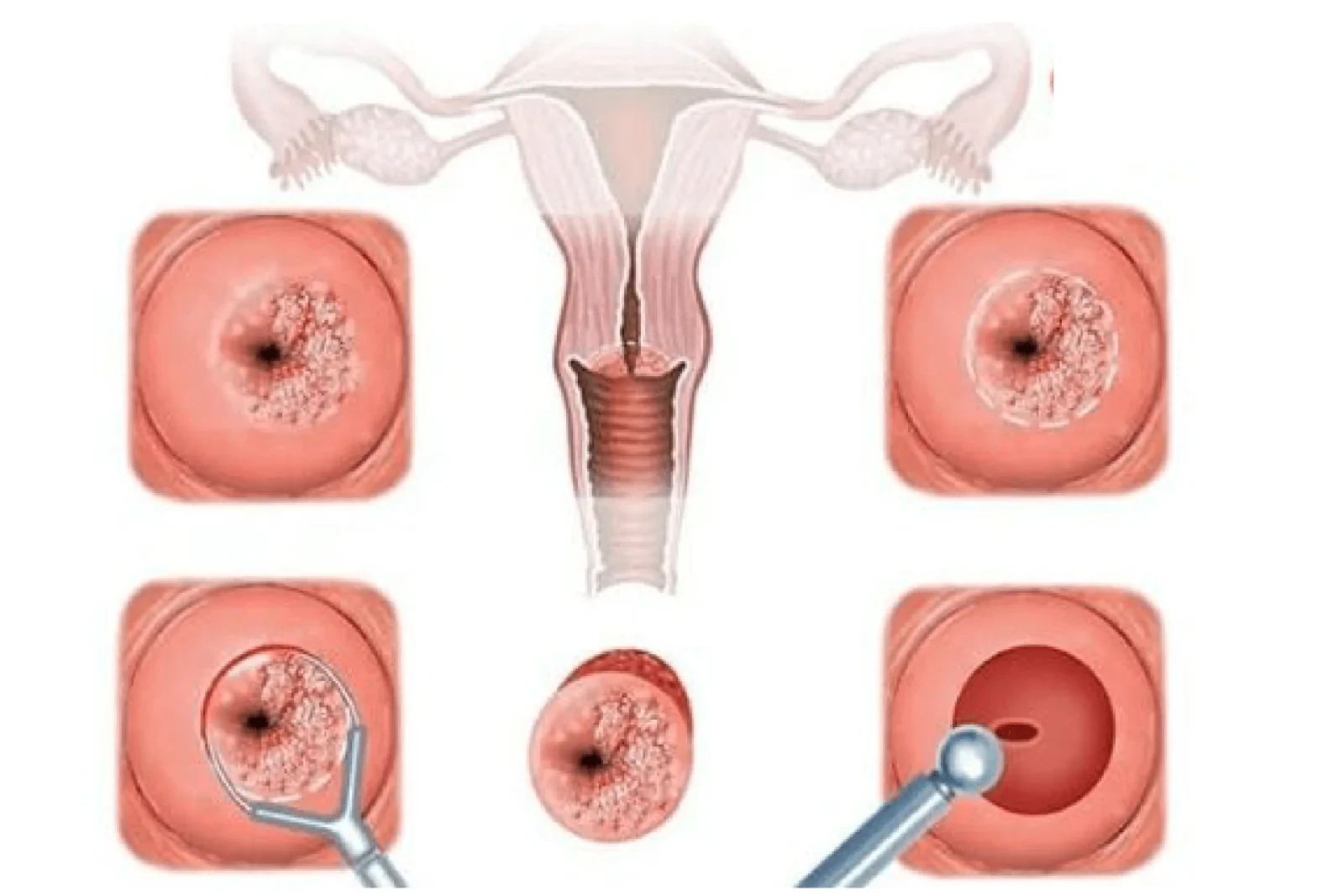Cách điều trị viêm cổ tử cung tại nhà hiệu quả