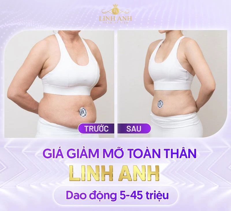 Bảng giá Thẩm mỹ viện Quốc tế Linh Anh cập nhật mới nhất