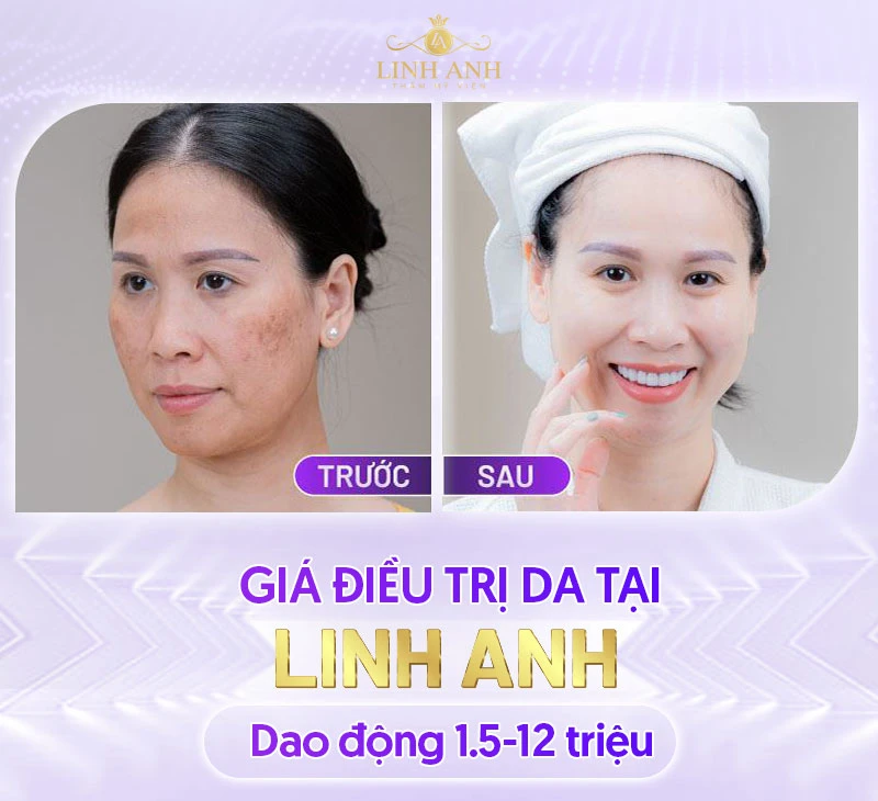 Bảng giá Thẩm mỹ viện Quốc tế Linh Anh cập nhật mới nhất