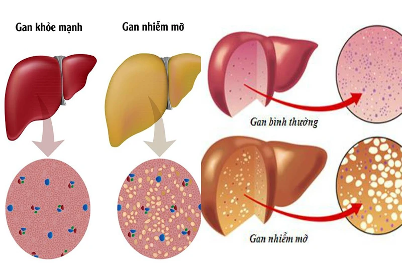 Bác sĩ hướng dẫn cách đọc chỉ số xét nghiệm gan