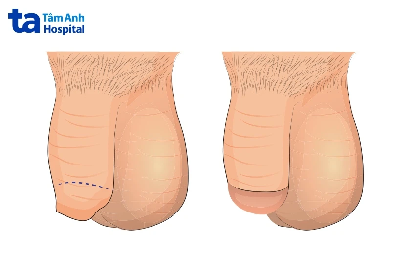 Bao quy đầu dài ở trẻ em: Nguyên nhân, hình ảnh và cách điều trị