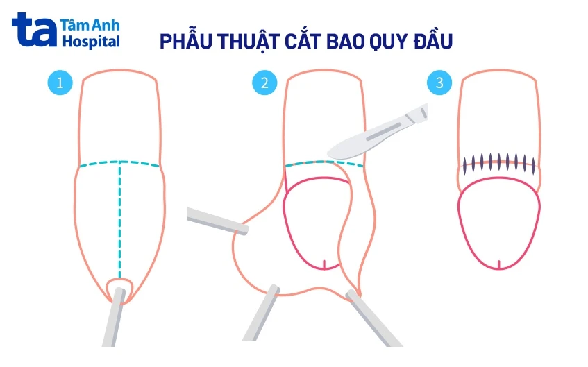 Bao quy đầu dài ở trẻ em: Nguyên nhân, hình ảnh và cách điều trị