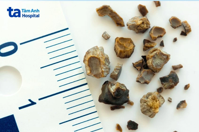 4 cách điều trị sỏi tiết niệu theo từng vị trí an toàn hiệu quả