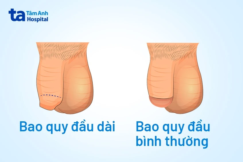 Dài bao quy đầu có quan hệ được không? Xử lý như thế nào?