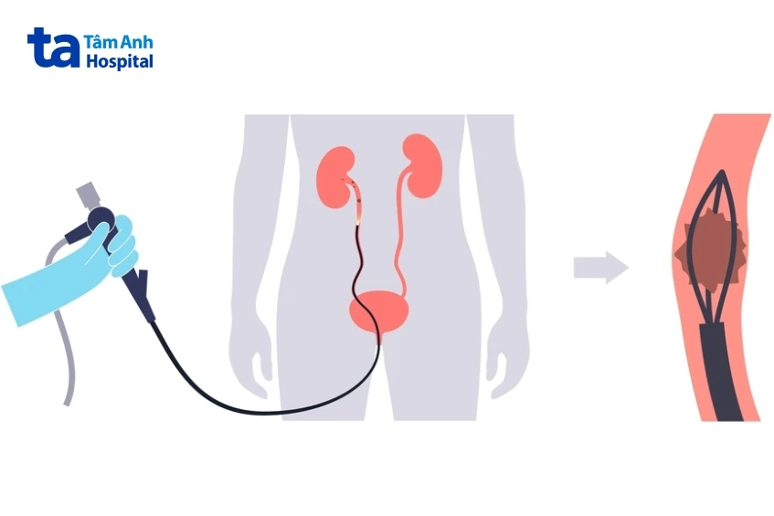4 cách điều trị sỏi tiết niệu theo từng vị trí an toàn hiệu quả