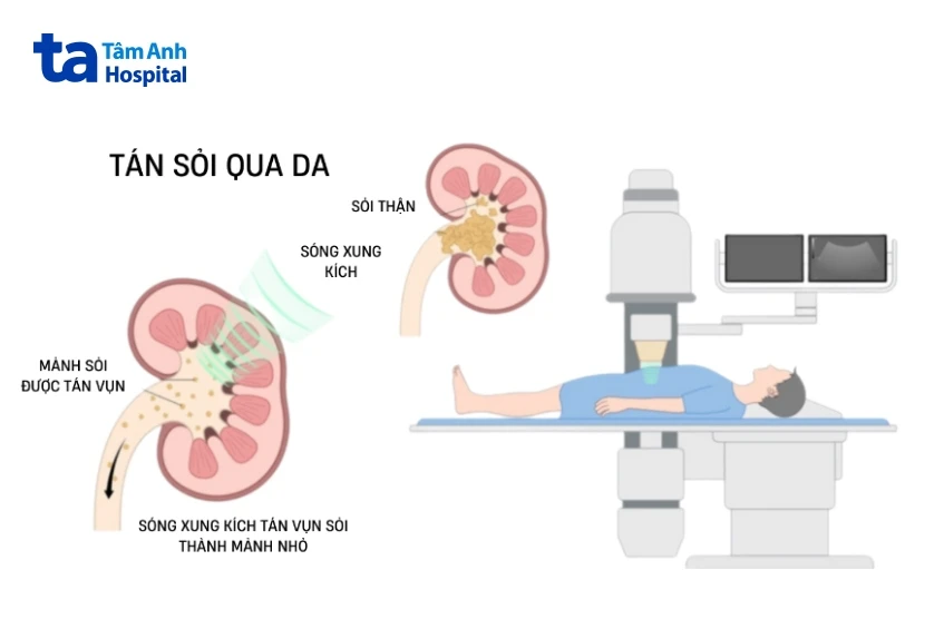 4 cách điều trị sỏi tiết niệu theo từng vị trí an toàn hiệu quả