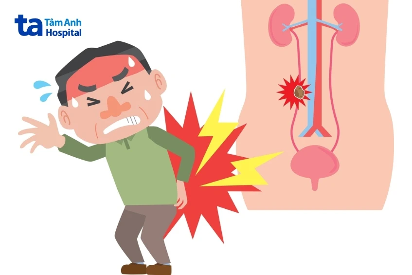 4 cách điều trị sỏi tiết niệu theo từng vị trí an toàn hiệu quả