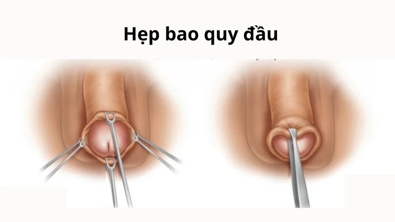 Hình ảnh bộ phận sinh dục bé trai bình thường là như thế nào?