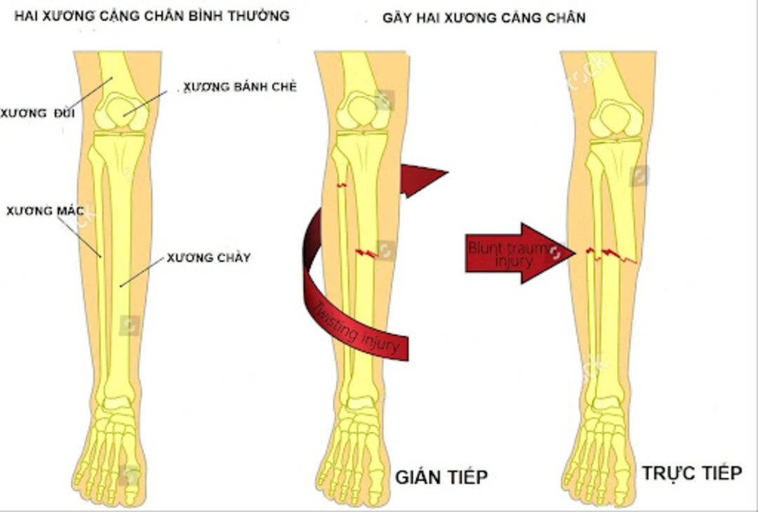 Dấu hiệu gãy chân là gì? Biến chứng thường gặp