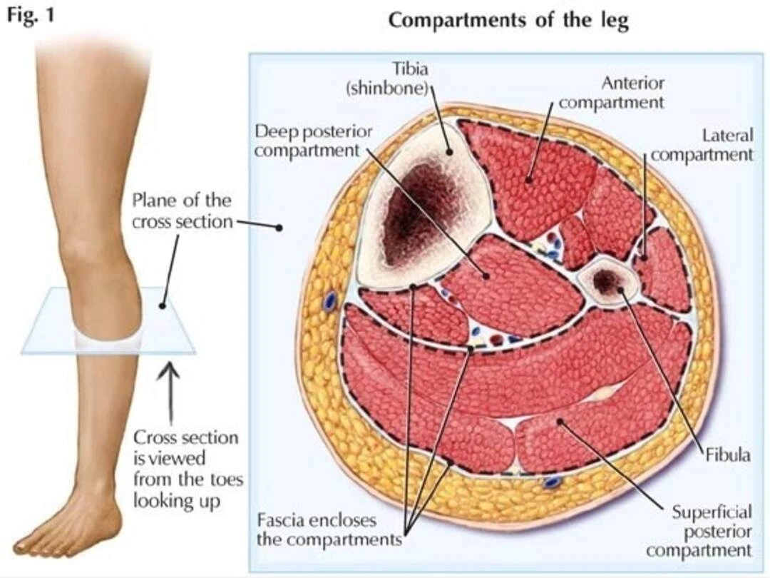 Dấu hiệu gãy chân là gì? Biến chứng thường gặp